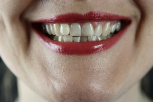 Bridging Gaps in Your Smile: A Guide to Teeth Gap Treatment